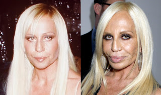 02-Botch-Plastic-Surgeries-Donatella-Versace-lifestyle-1.jpg